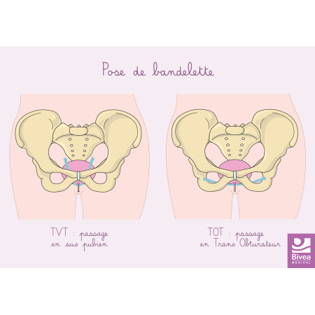 Carte anatomique Pose de...