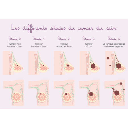 Schéma détaillant les différents stades d'un cancer du sein