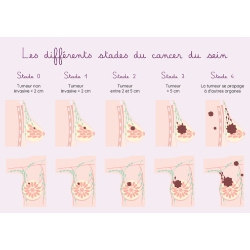 Schéma détaillant les différents stades d'un cancer du sein